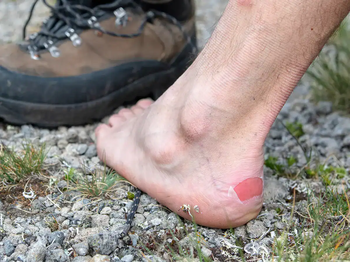 blister on a hikers foot